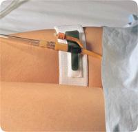 Dale Foley Cath Holder, Leg Band 2in X 19.5in 316 — Each — product image